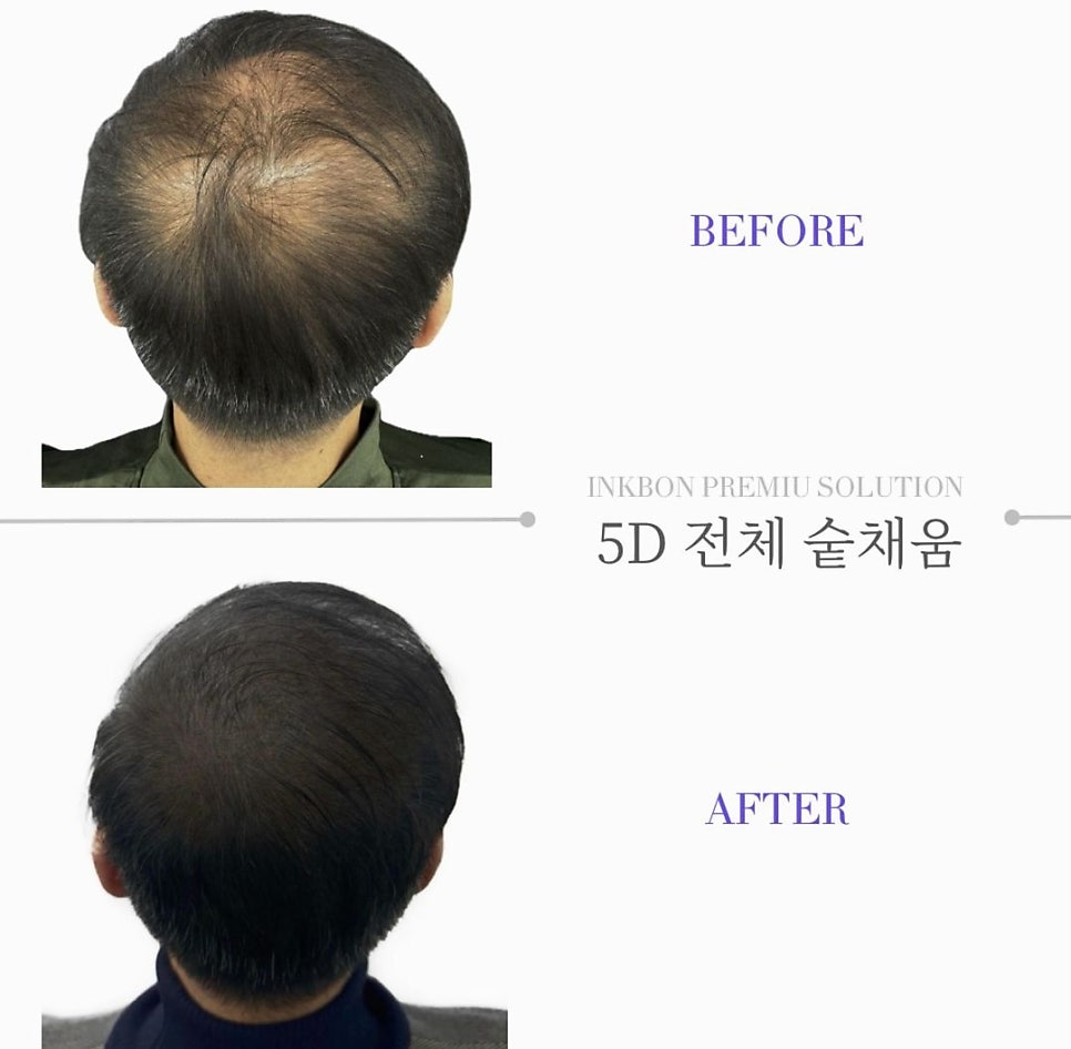 두피문신 작업