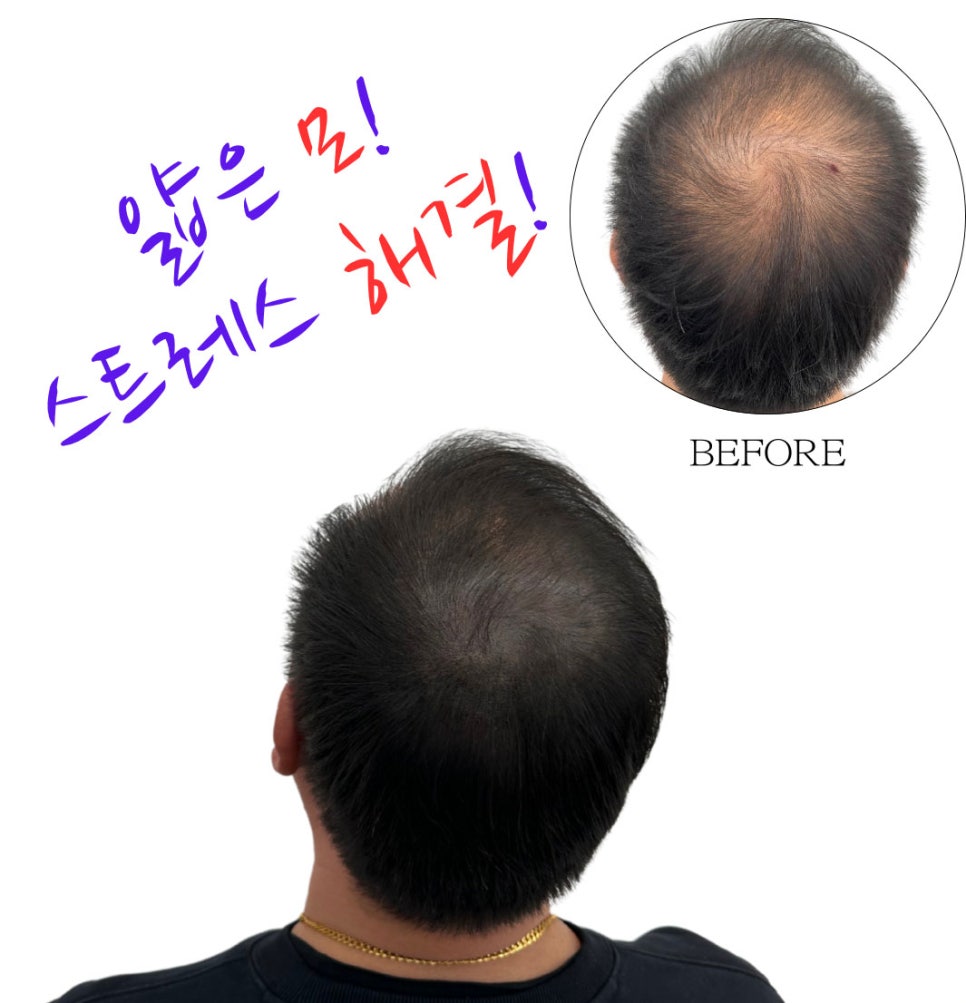 두피문신 작업