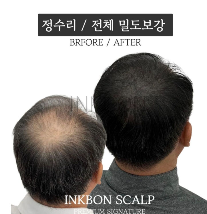 두피문신 작업